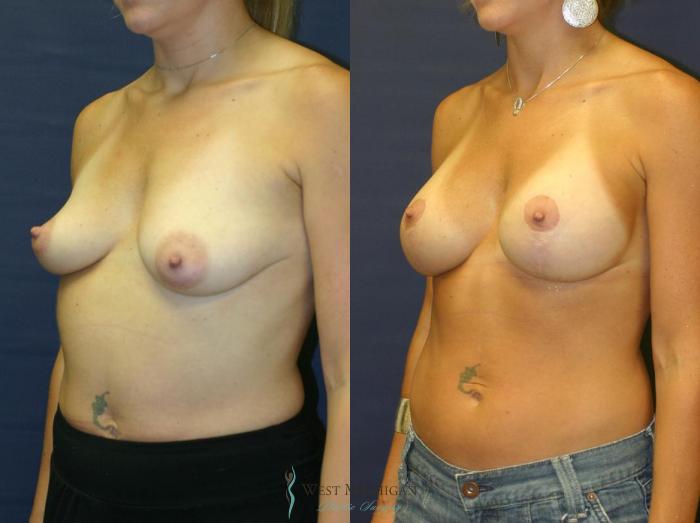 Before & After Breast Augmentation with Lift Case 8719 View #3 View in Portage, Kalamazoo, Battle Creek, Michigan