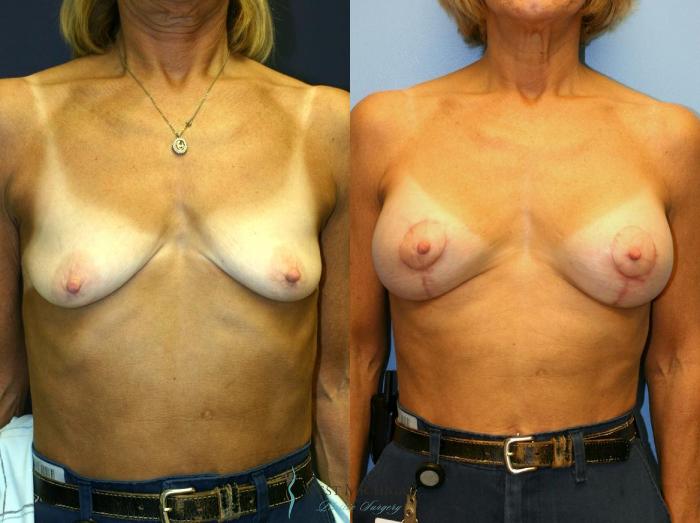 Before & After Breast Augmentation with Lift Case 8910 View #1 View in Portage, Kalamazoo, Battle Creek, Michigan
