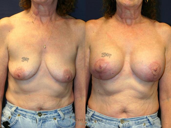 Before & After Breast Augmentation with Lift Case 8914 View #1 View in Portage, Kalamazoo, Battle Creek, Michigan
