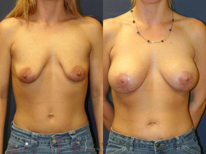 Before & After Breast Augmentation with Lift Case 8915 View #1 View in Portage, Kalamazoo, Battle Creek, Michigan