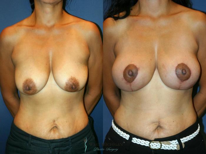 Before & After Breast Augmentation with Lift Case 8916 View #1 View in Portage, Kalamazoo, Battle Creek, Michigan