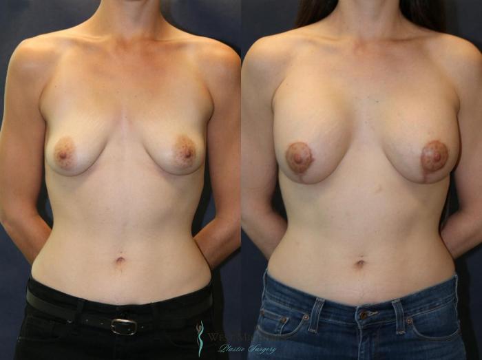 Before & After Breast Augmentation with Lift Case 8917 View #1 View in Portage, Kalamazoo, Battle Creek, Michigan