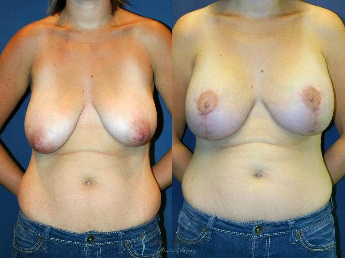 Before & After Breast Augmentation with Lift Case 8918 View #1 View in Portage, Kalamazoo, Battle Creek, Michigan