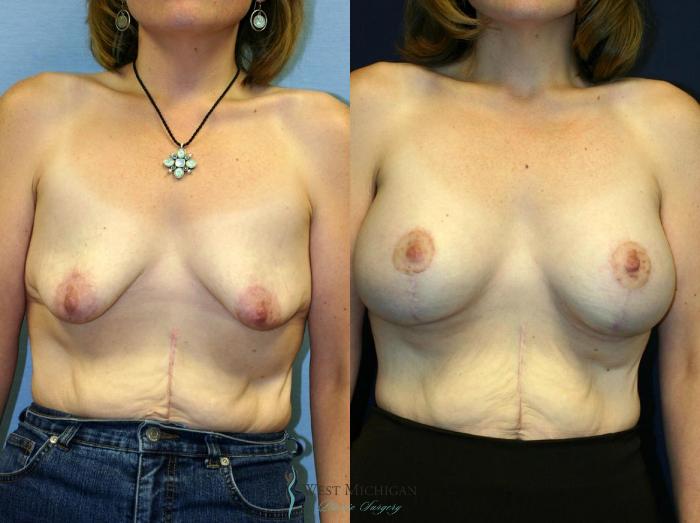 Before & After Breast Augmentation with Lift Case 8921 View #1 View in Portage, Kalamazoo, Battle Creek, Michigan