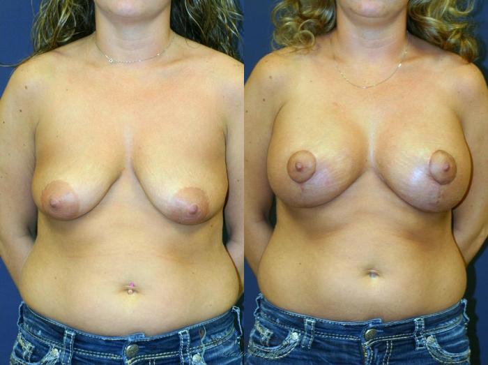 Before & After Breast Augmentation with Lift Case 8922 View #1 View in Portage, Kalamazoo, Battle Creek, Michigan