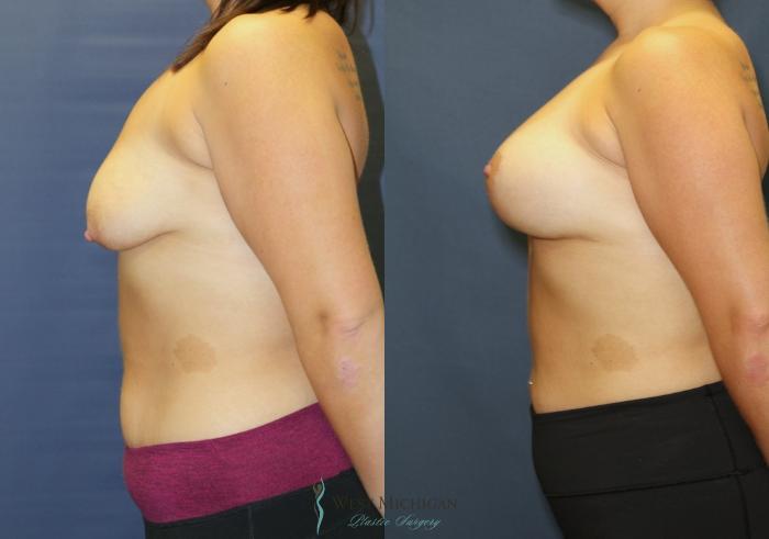 Before & After Breast Augmentation with Lift Case 9391 Left Side View in Portage, Kalamazoo, Battle Creek, Michigan