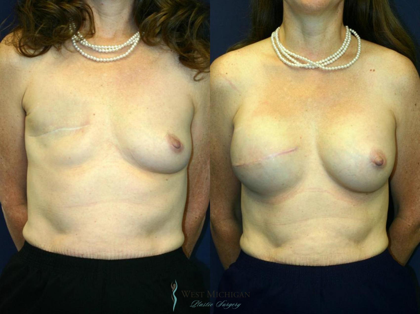 Before & After Breast Reconstruction Case 8727 View #1 View in Kalamazoo & Grand Rapids, Michigan