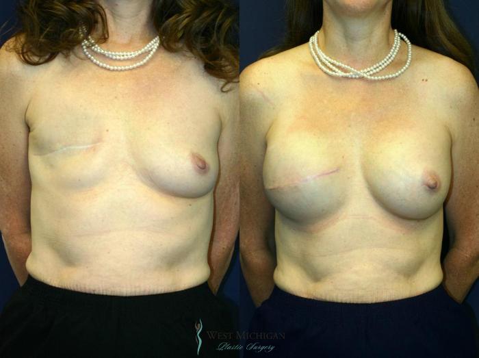 Before & After Breast Reconstruction Case 8727 View #1 View in Portage, Kalamazoo, Battle Creek, Michigan