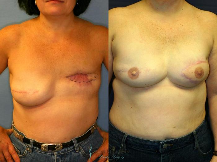 Before & After Breast Reconstruction Case 8936 View #1 View in Portage, Kalamazoo, Battle Creek, Michigan