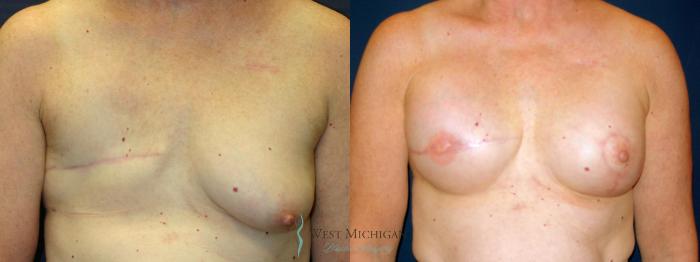 Before & After Breast Reconstruction Case 8937 View #1 View in Portage, Kalamazoo, Battle Creek, Michigan