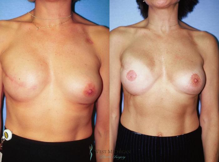 Before & After Breast Reconstruction Case 8939 View #1 View in Portage, Kalamazoo, Battle Creek, Michigan