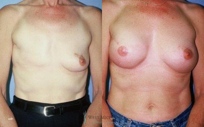 Before & After Breast Reconstruction Case 8940 View #1 View in Portage, Kalamazoo, Battle Creek, Michigan