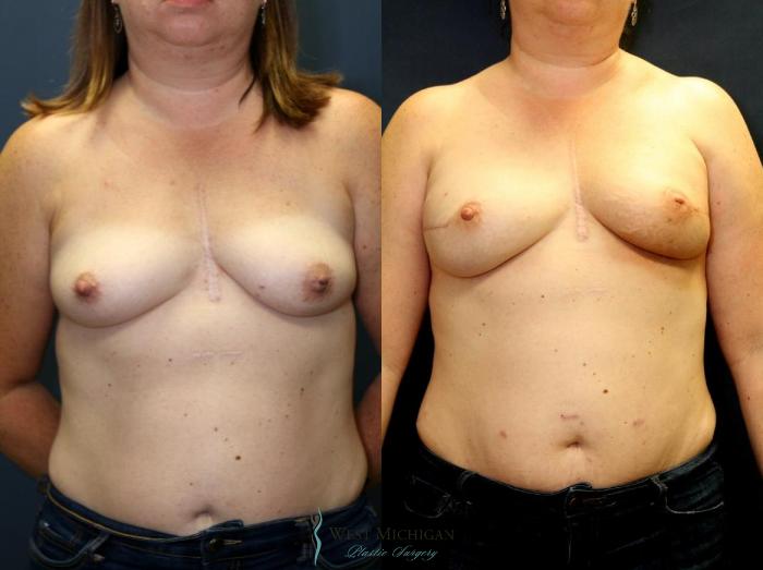 Before & After Breast Reconstruction Case 8941 View #1 View in Portage, Kalamazoo, Battle Creek, Michigan