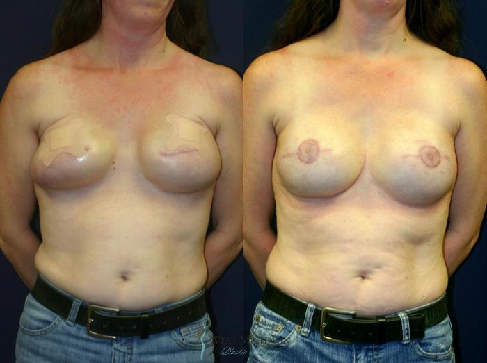 Before & After Breast Reconstruction Case 8942 View #1 View in Portage, Kalamazoo, Battle Creek, Michigan