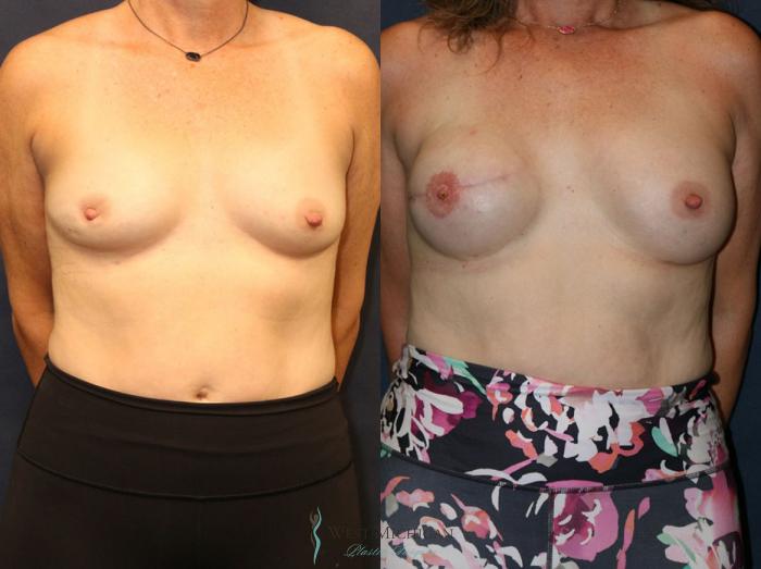Before & After Breast Reconstruction Case 8943 View #1 View in Portage, Kalamazoo, Battle Creek, Michigan