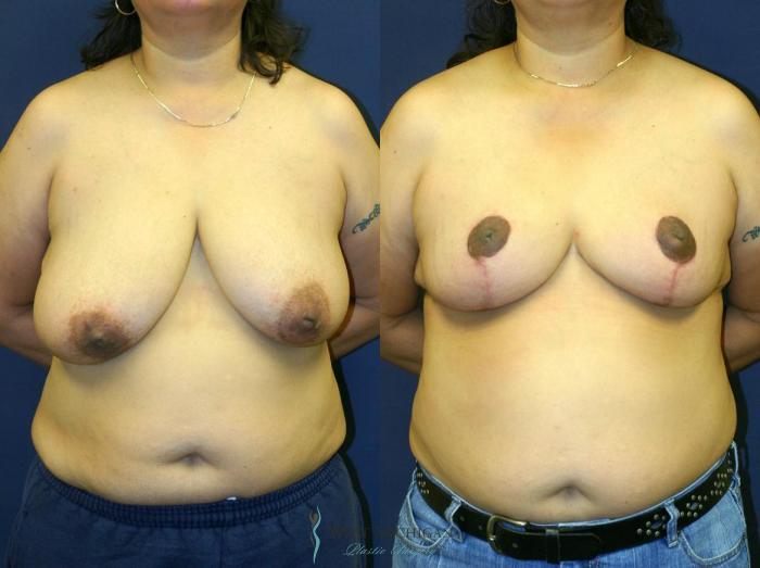 Before & After Breast Reduction Case 9117 View #1 View in Portage, Kalamazoo, Battle Creek, Michigan