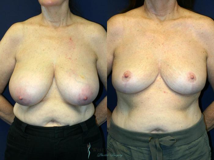 Before & After Breast Reduction Case 9118 View #1 View in Portage, Kalamazoo, Battle Creek, Michigan