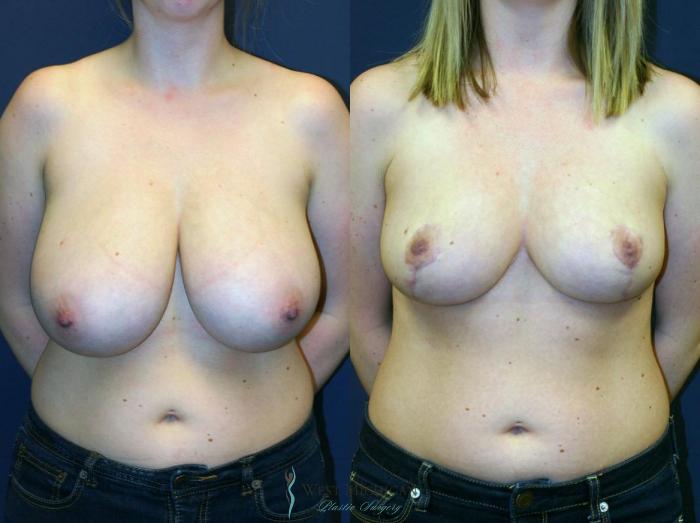 Before & After Breast Reduction Case 9119 View #1 View in Portage, Kalamazoo, Battle Creek, Michigan