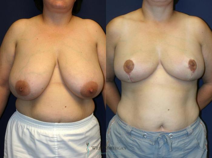 Before & After Breast Reduction Case 9120 View #1 View in Portage, Kalamazoo, Battle Creek, Michigan