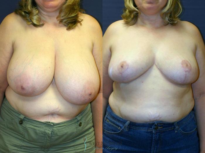 Before & After Breast Reduction Case 9121 View #1 View in Portage, Kalamazoo, Battle Creek, Michigan