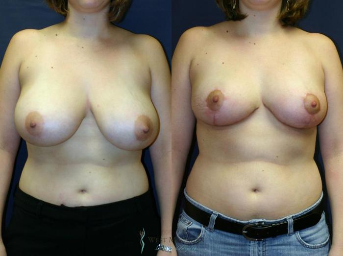 Before & After Breast Reduction Case 9123 View #1 View in Portage, Kalamazoo, Battle Creek, Michigan