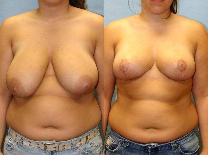 Before & After Breast Reduction Case 9125 View #1 View in Portage, Kalamazoo, Battle Creek, Michigan