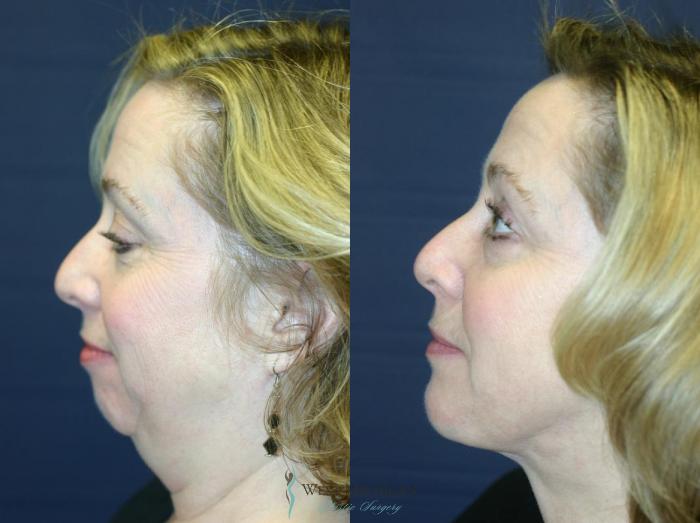 Before & After Chin Augmentation Case 8839 View #2 View in Portage, Kalamazoo, Battle Creek, Michigan