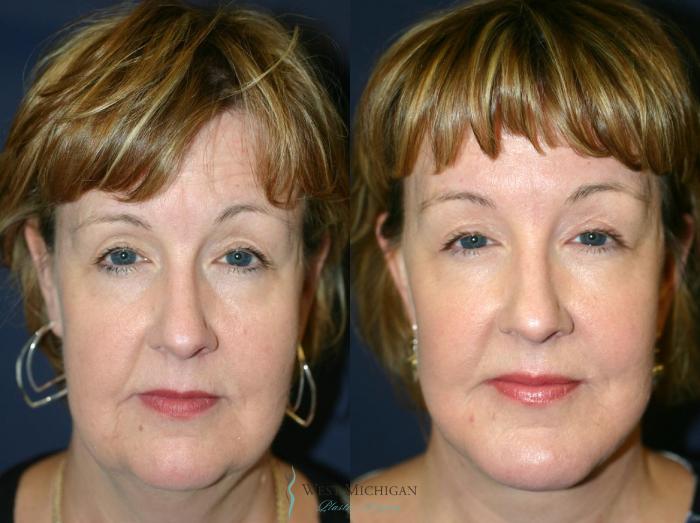 Before & After Chin Augmentation Case 8840 View #1 View in Portage, Kalamazoo, Battle Creek, Michigan