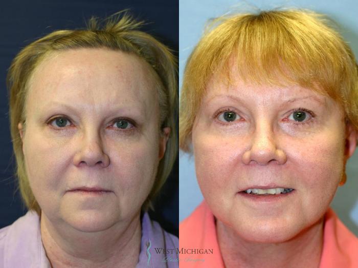 Before & After Chin Augmentation Case 8841 View #1 View in Portage, Kalamazoo, Battle Creek, Michigan