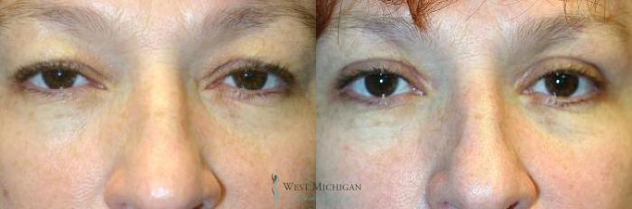 Before & After Eyelid Surgery Case 8846 View #1 View in Portage, Kalamazoo, Battle Creek, Michigan