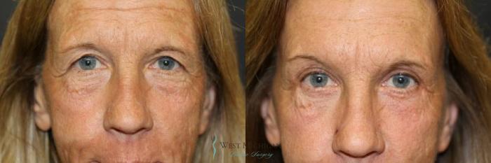Before & After Eyelid Surgery Case 8847 View #1 View in Portage, Kalamazoo, Battle Creek, Michigan