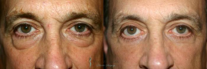 Before & After Eyelid Surgery Case 8852 View #1 View in Portage, Kalamazoo, Battle Creek, Michigan