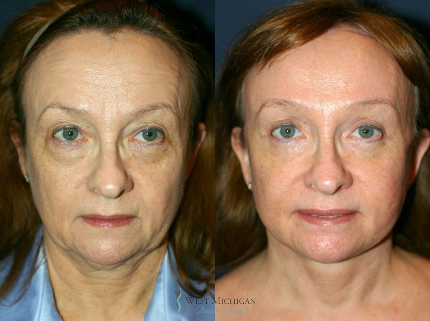 Before & After Facelift Case 8739 View #1 View in Kalamazoo & Grand Rapids, Michigan