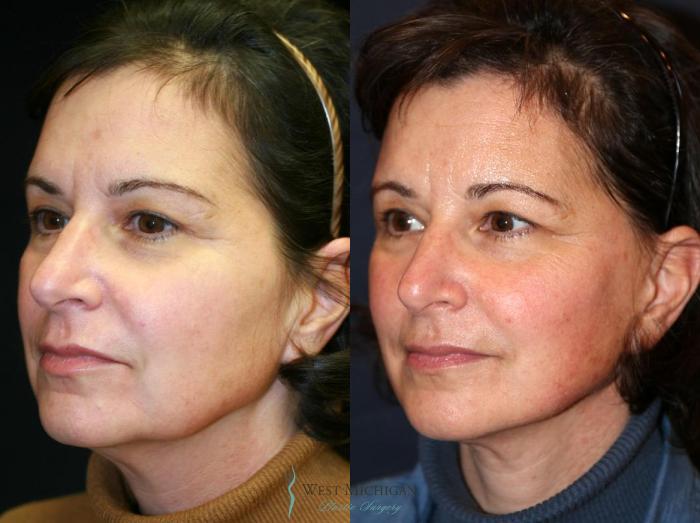 Before & After Facelift Case 8873 View #3 View in Portage, Kalamazoo, Battle Creek, Michigan