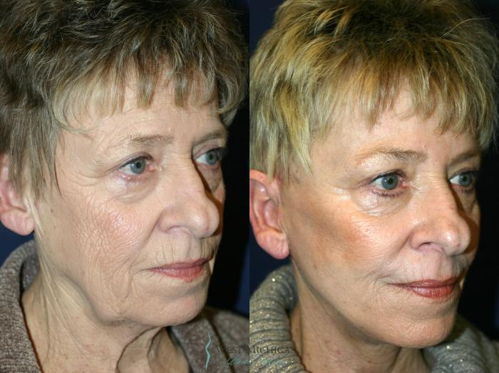 Before & After Facelift Case 8876 View #3 View in Portage, Kalamazoo, Battle Creek, Michigan