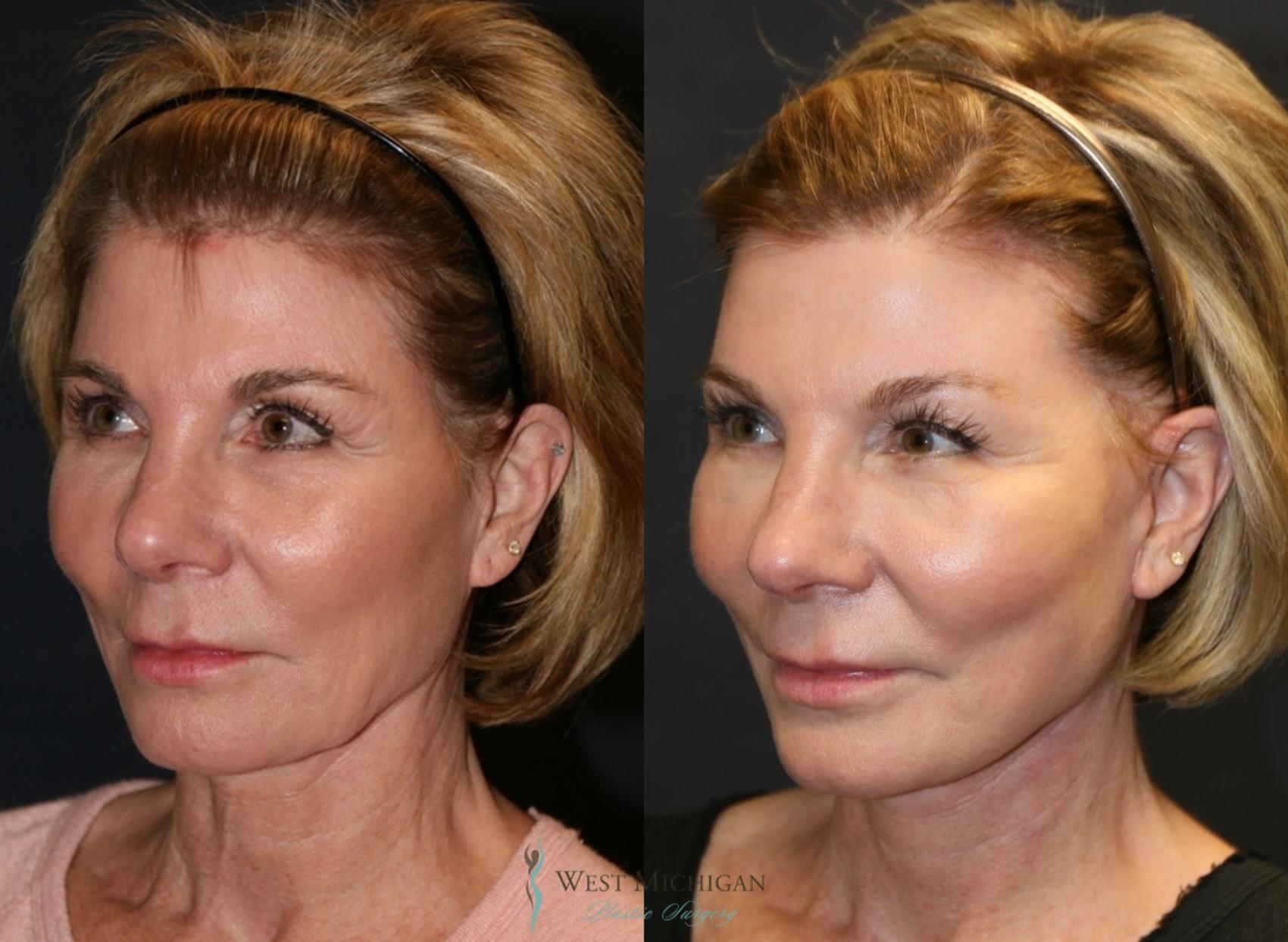 Before & After Facelift Case 9350 Left Oblique View in Kalamazoo & Grand Rapids, Michigan