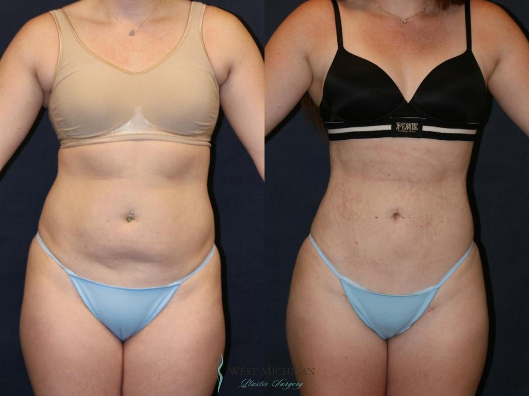 Before & After Liposuction Case 9320 View #1 View in Kalamazoo & Grand Rapids, Michigan