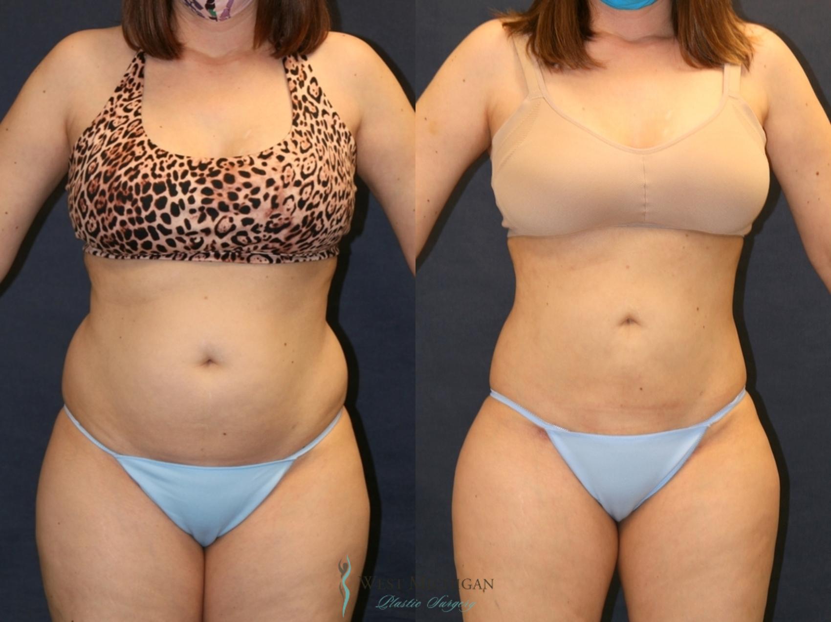 Before & After Liposuction Case 9332 Front View in Kalamazoo & Grand Rapids, Michigan