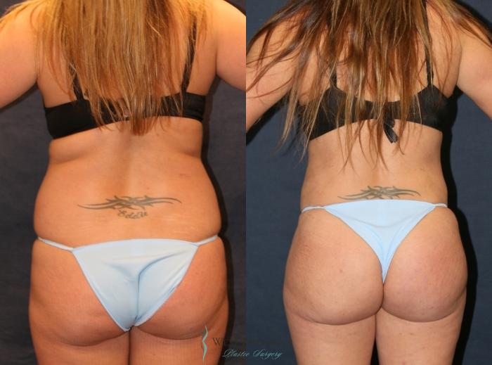 Before & After Liposuction Case 9359 Back View in Portage, Kalamazoo, Battle Creek, Michigan
