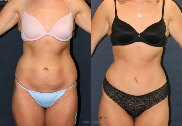 Before & After Liposuction Case 9387 Front View in Portage, Kalamazoo, Battle Creek, Michigan