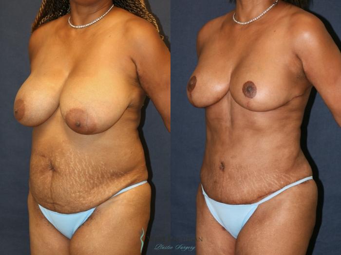 Before & After Mommy Makeover Case 9364 Left Oblique View in Portage, Kalamazoo, Battle Creek, Michigan