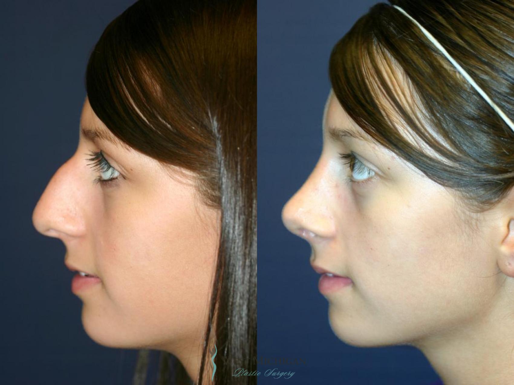 Before & After Nose Surgery Case 8742 View #2 View in Kalamazoo & Grand Rapids, Michigan