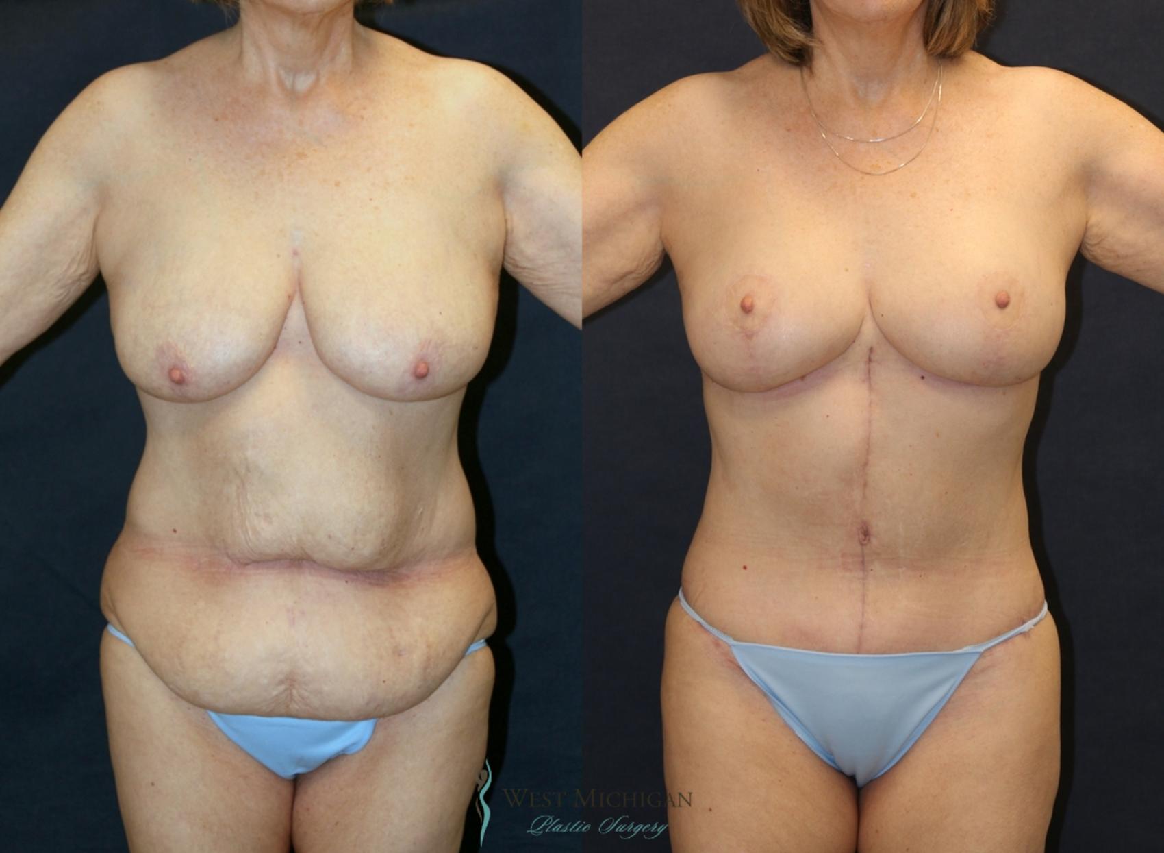Before & After Post Weight Loss Case 9336 Front View in Kalamazoo & Grand Rapids, Michigan