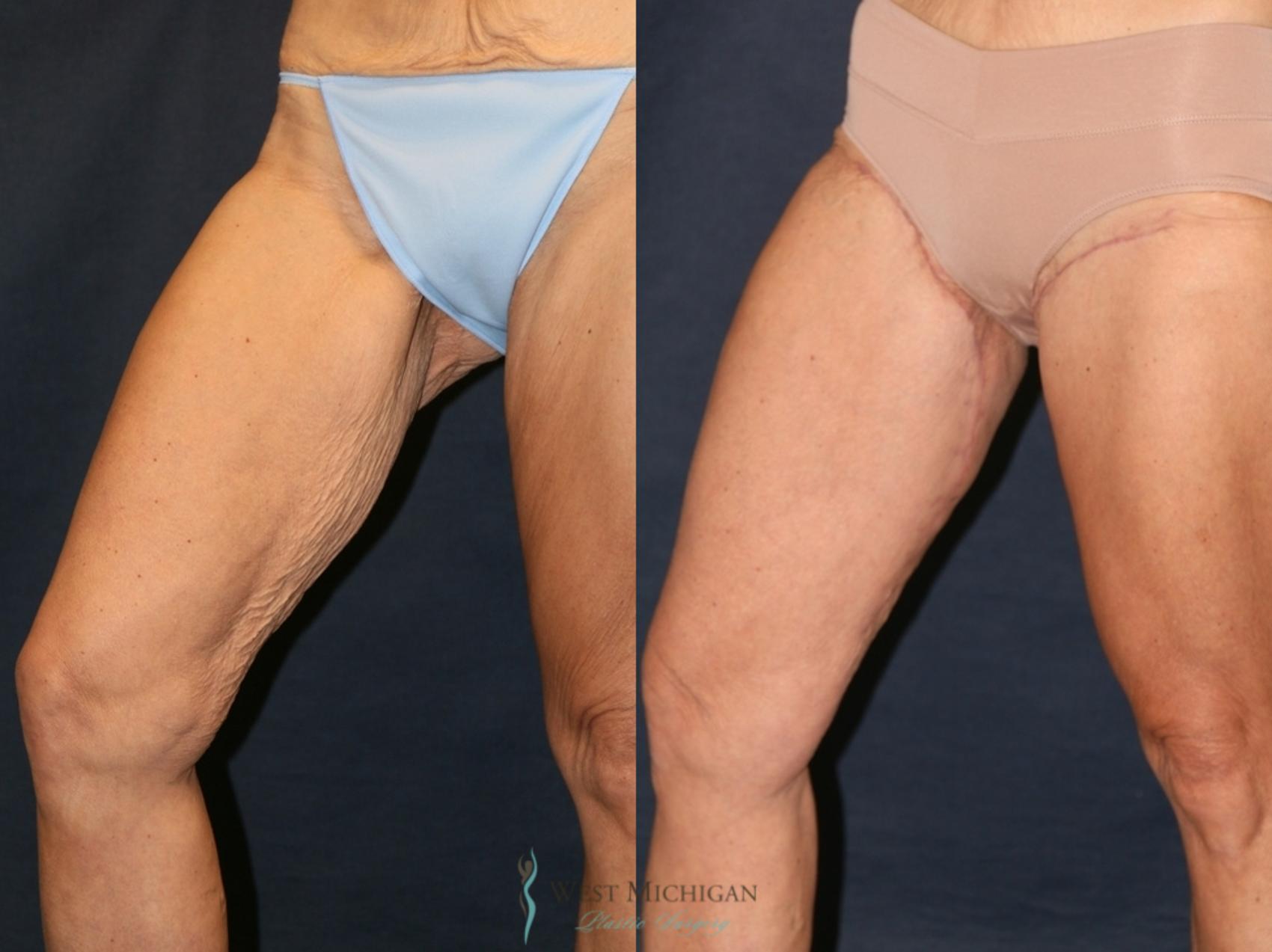 Before & After Thigh Lift Case 9328 Right Side View in Portage, Kalamazoo, Battle Creek, Michigan