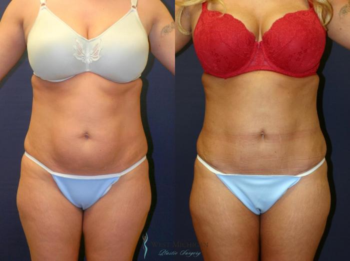 Before & After Tummy Tuck Case 9057 View #1 View in Portage, Kalamazoo, Battle Creek, Michigan
