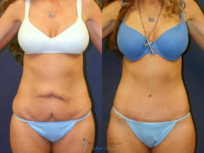 Before & After Tummy Tuck Case 9372 Front View in Portage, Kalamazoo, Battle Creek, Michigan