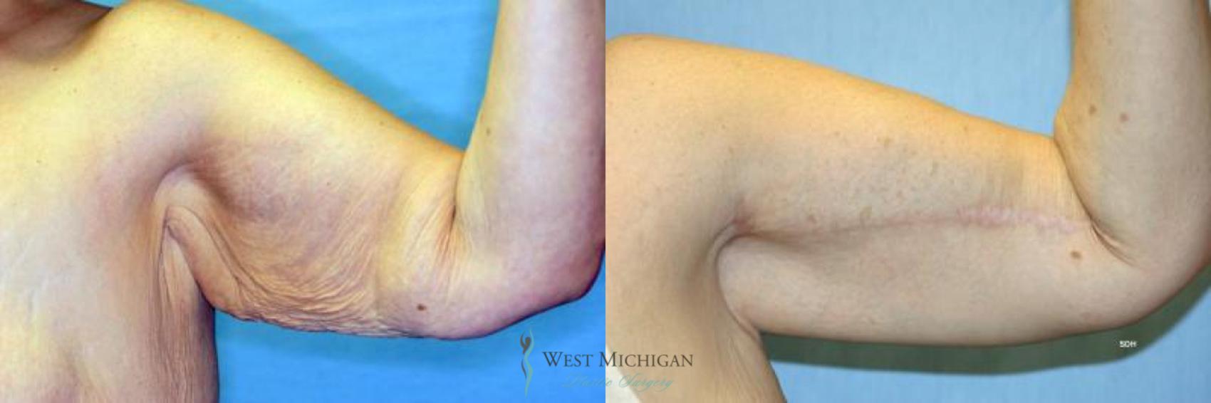 Before & After Arm Lift Case 8699 View #1 View in Portage, Kalamazoo, Battle Creek, Michigan