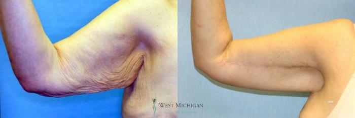 Before & After Arm Lift Case 8699 View #2 View in Portage, Kalamazoo, Battle Creek, Michigan