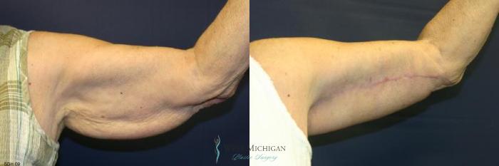 Before & After Arm Lift Case 8700 View #1 View in Kalamazoo & Grand Rapids, Michigan