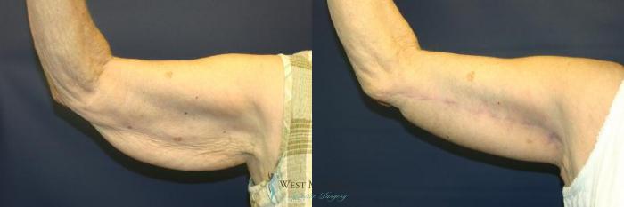 Before & After Arm Lift Case 8700 View #2 View in Kalamazoo & Grand Rapids, Michigan
